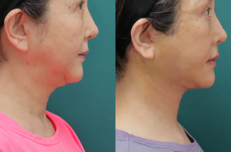 Deep Plane Facelift to improve hidden facial sagging