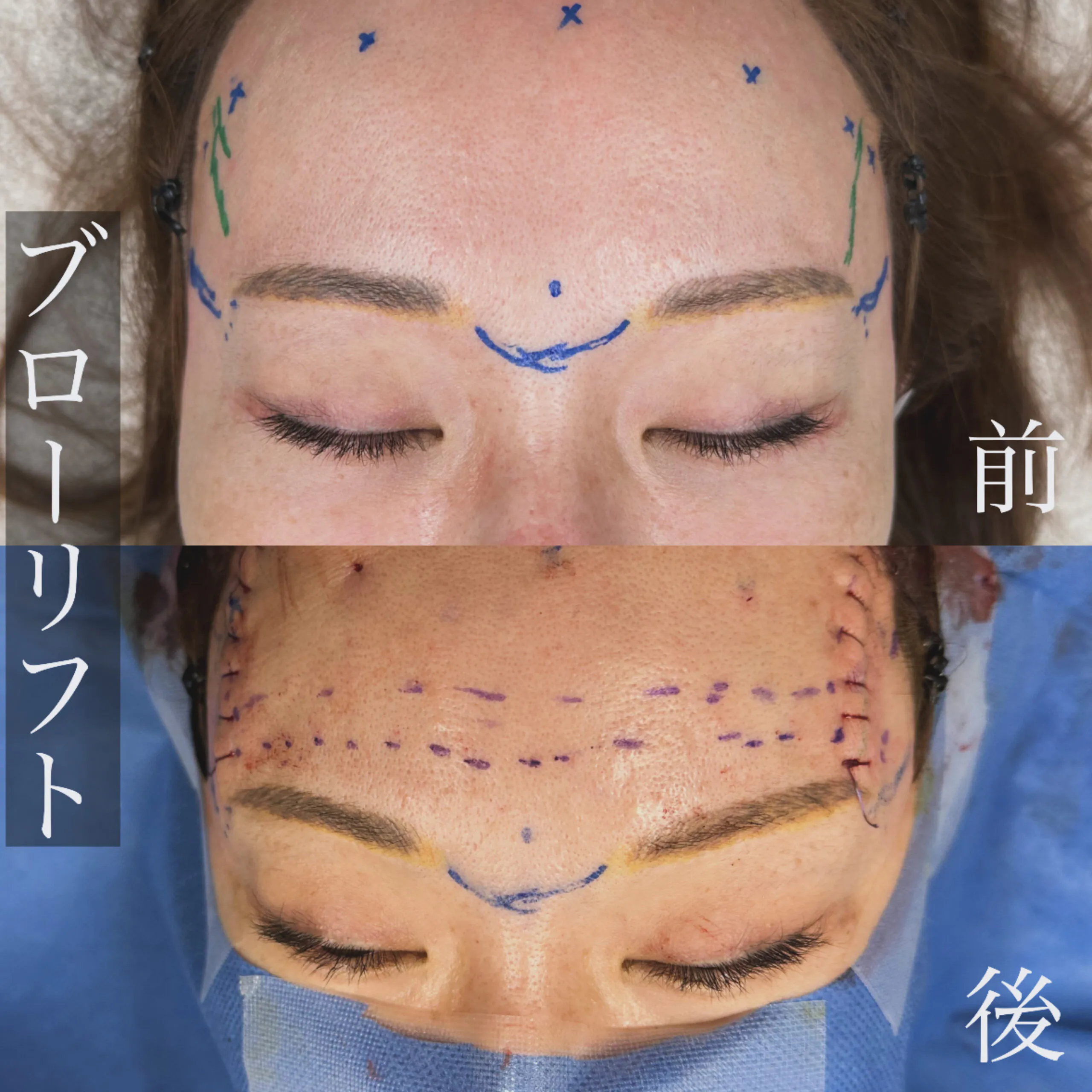 Forehead lift or Brow lift with endoscopic surgery