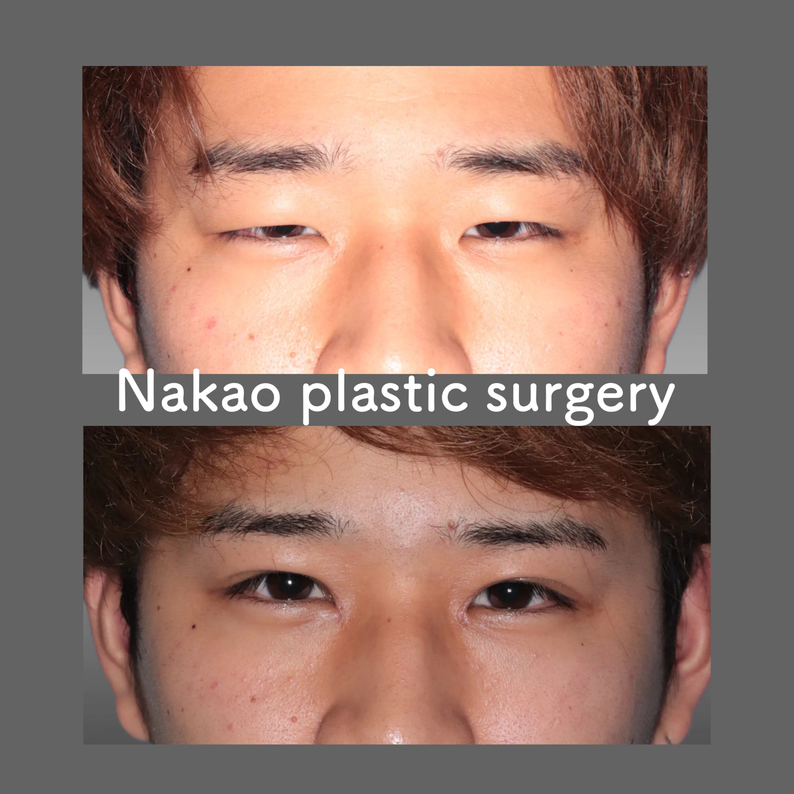 Asian Upper Blepharoplasty Double Eyelid Surgery