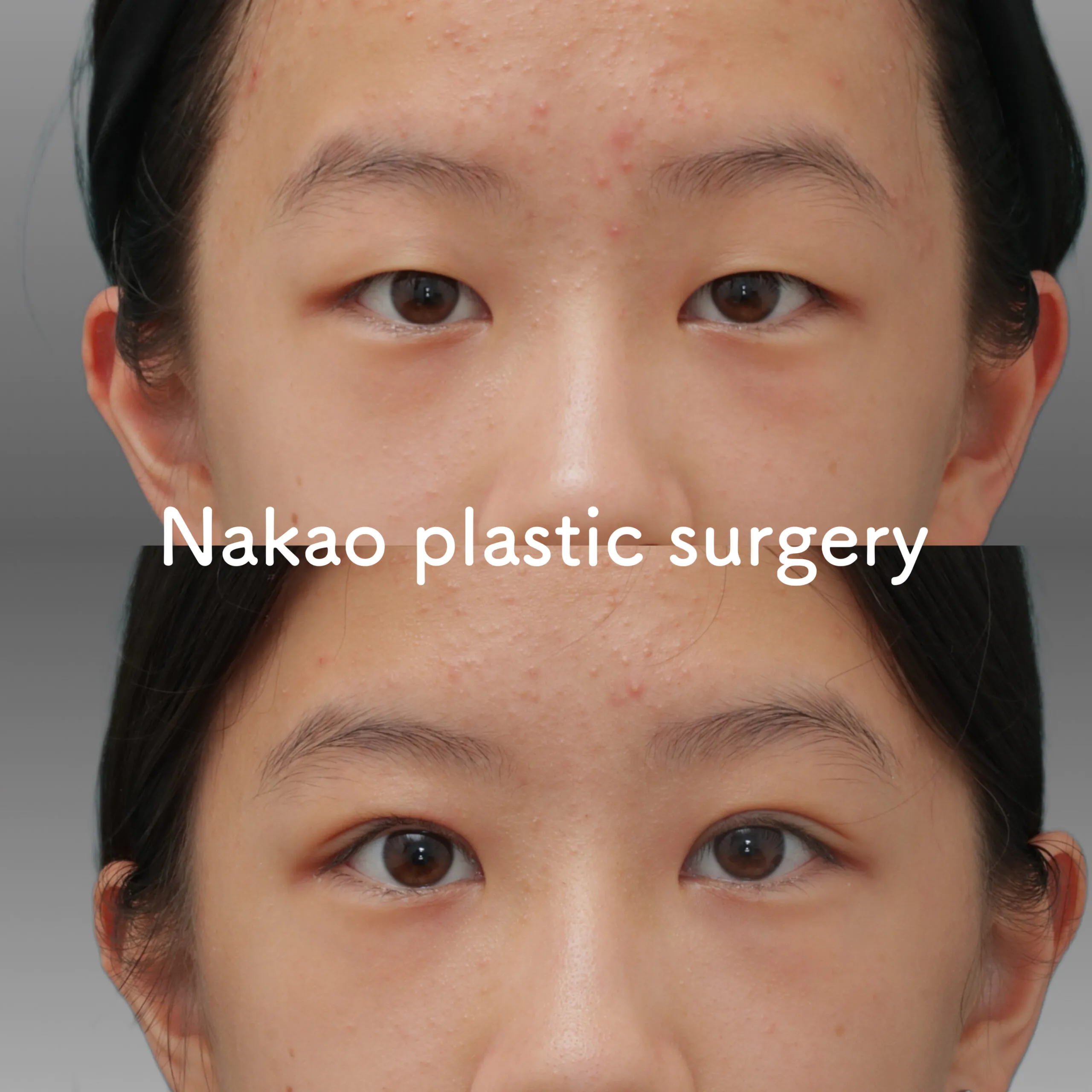 Asian Upper Blepharoplasty Double Eyelid Surgery　