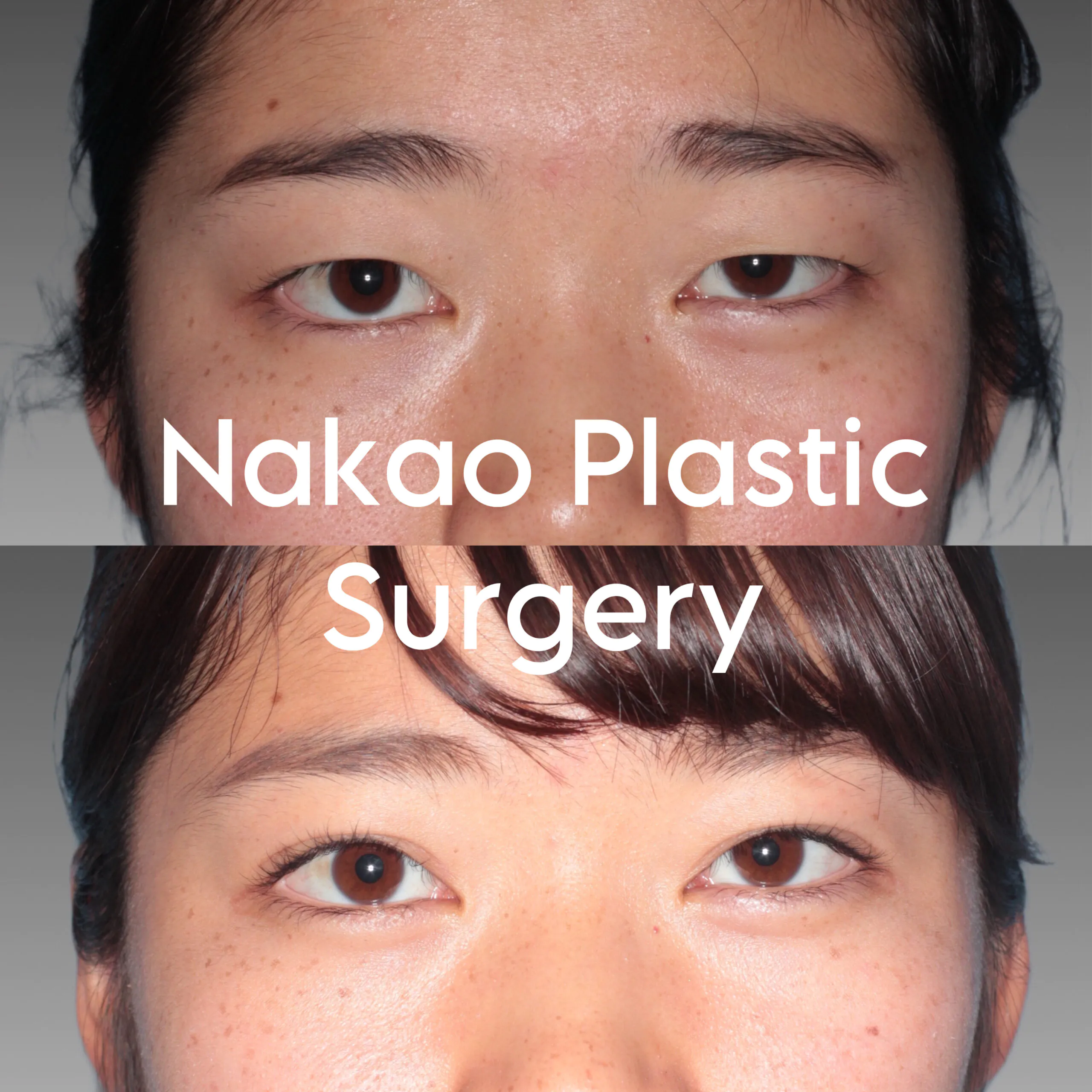 Asian Upper Blepharoplasty