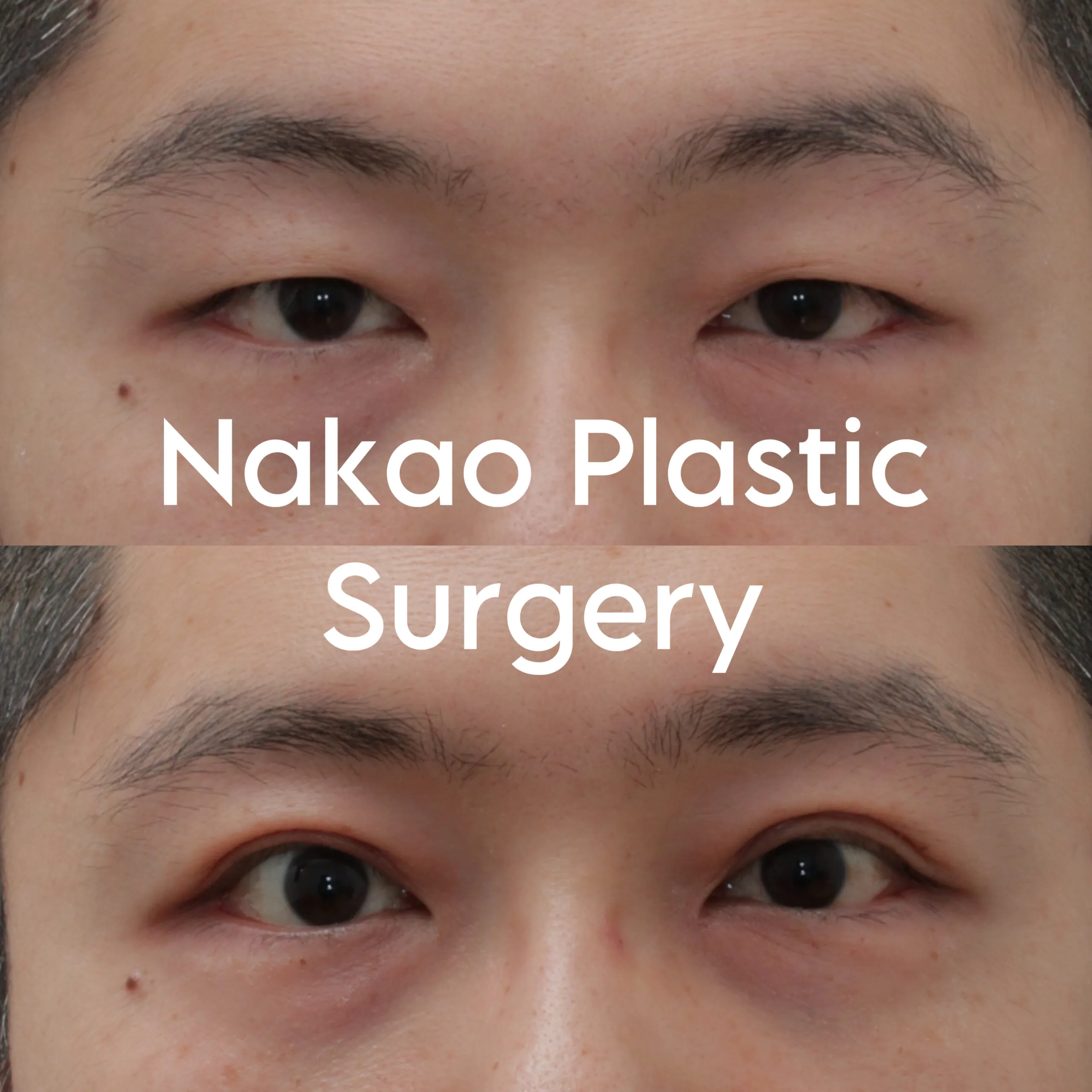 Asian Upper Blepharoplasty  Double Eyelid Surgery