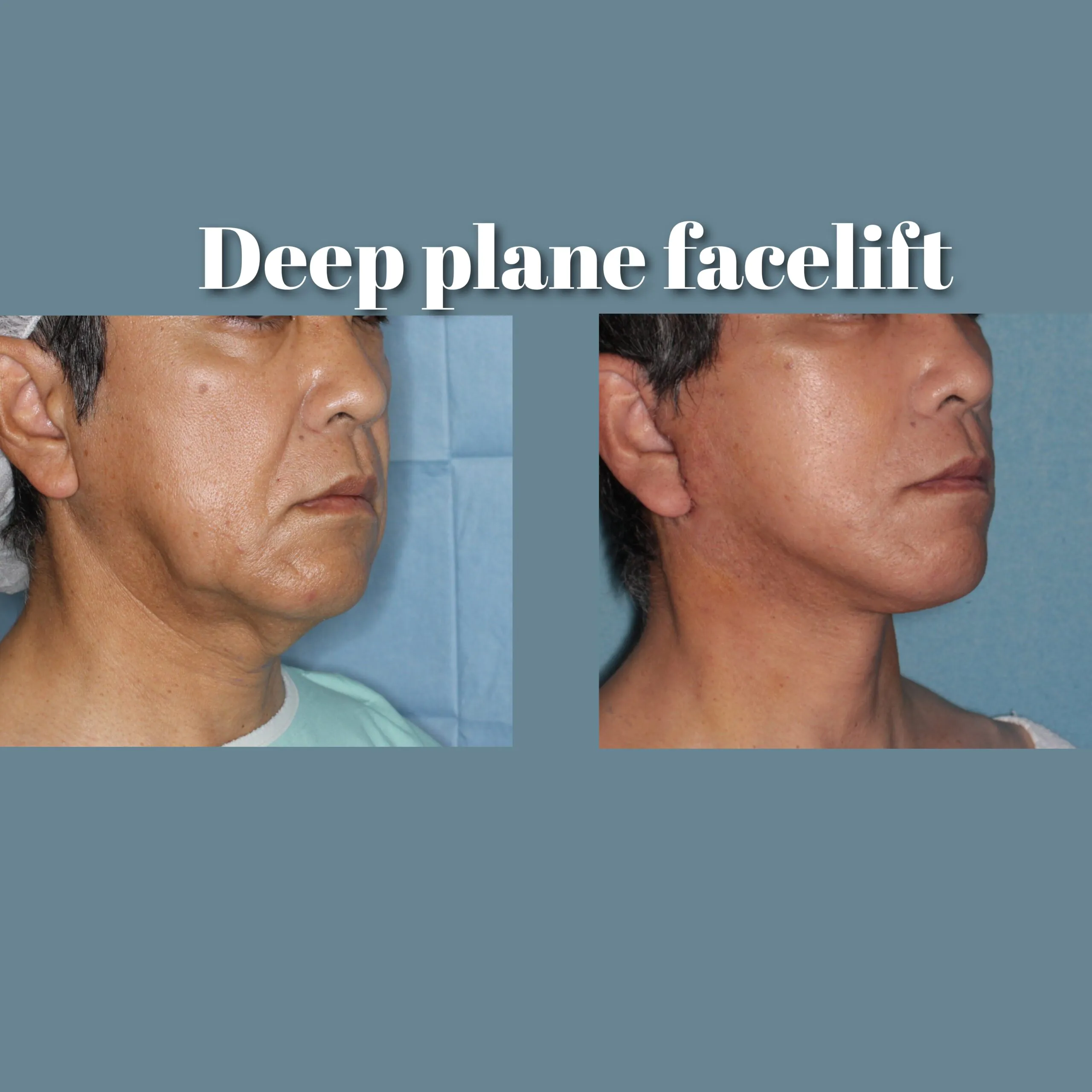 Deep Plane Facelift Case