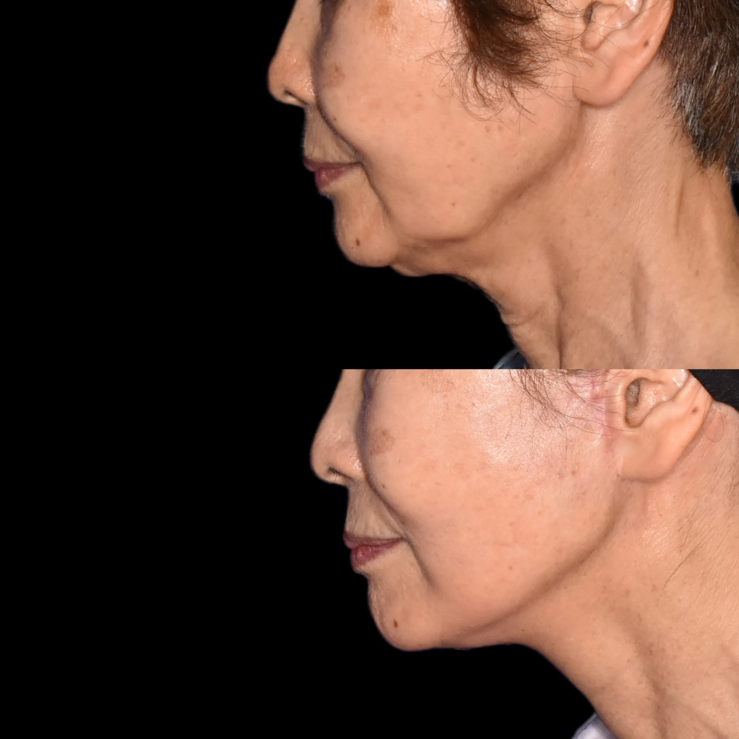 Deep Plane Facelift Postoperative Progress